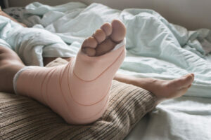 Bandaged foot raised up on pillow Work Injury Lawyer Marietta GA